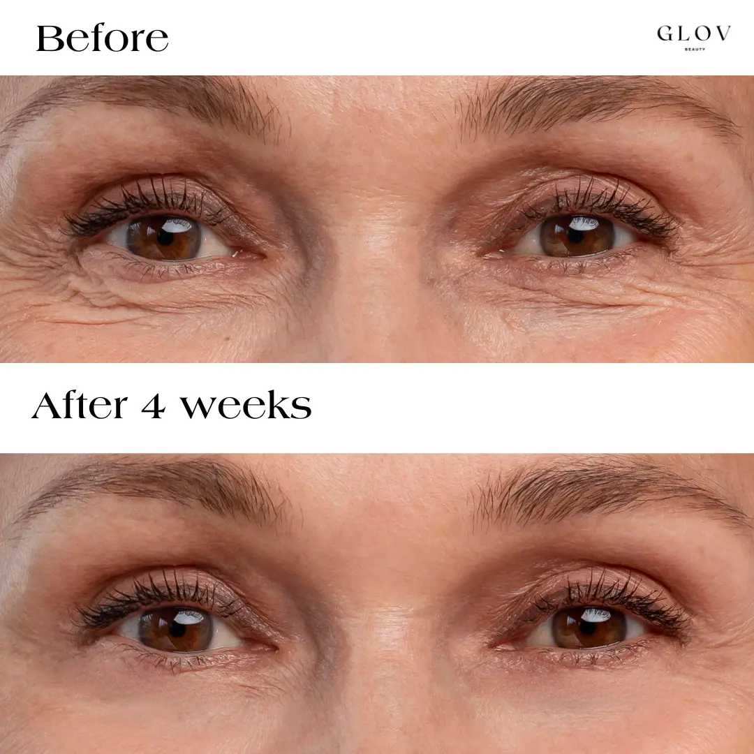 2 Glov Micro Infusion System + 6 Serums + 4 Needles + 16 Pairs Microneedle Eye Patches - Image 7