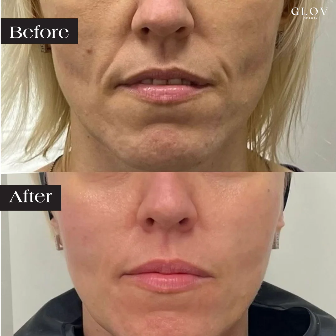Glov LED Face Mask Anti-Aging Therapy - Image 3