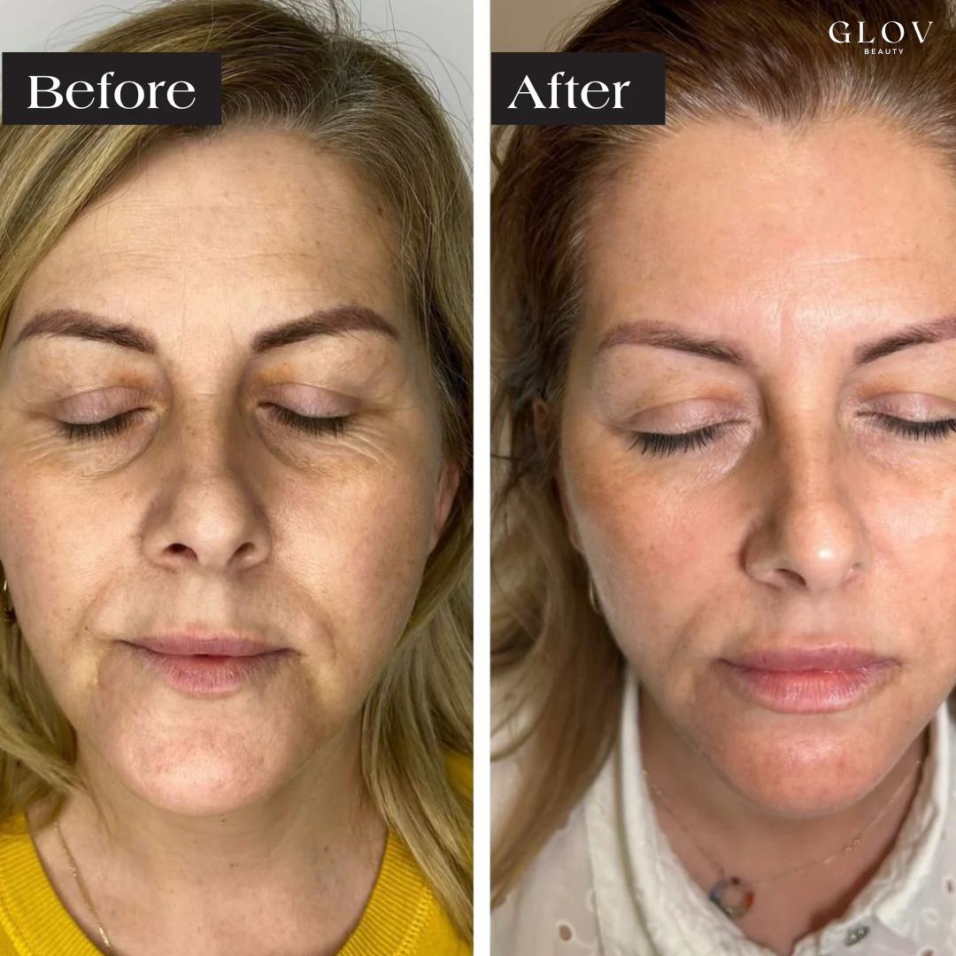Glov LED Face Mask Anti-Aging Therapy - Image 4