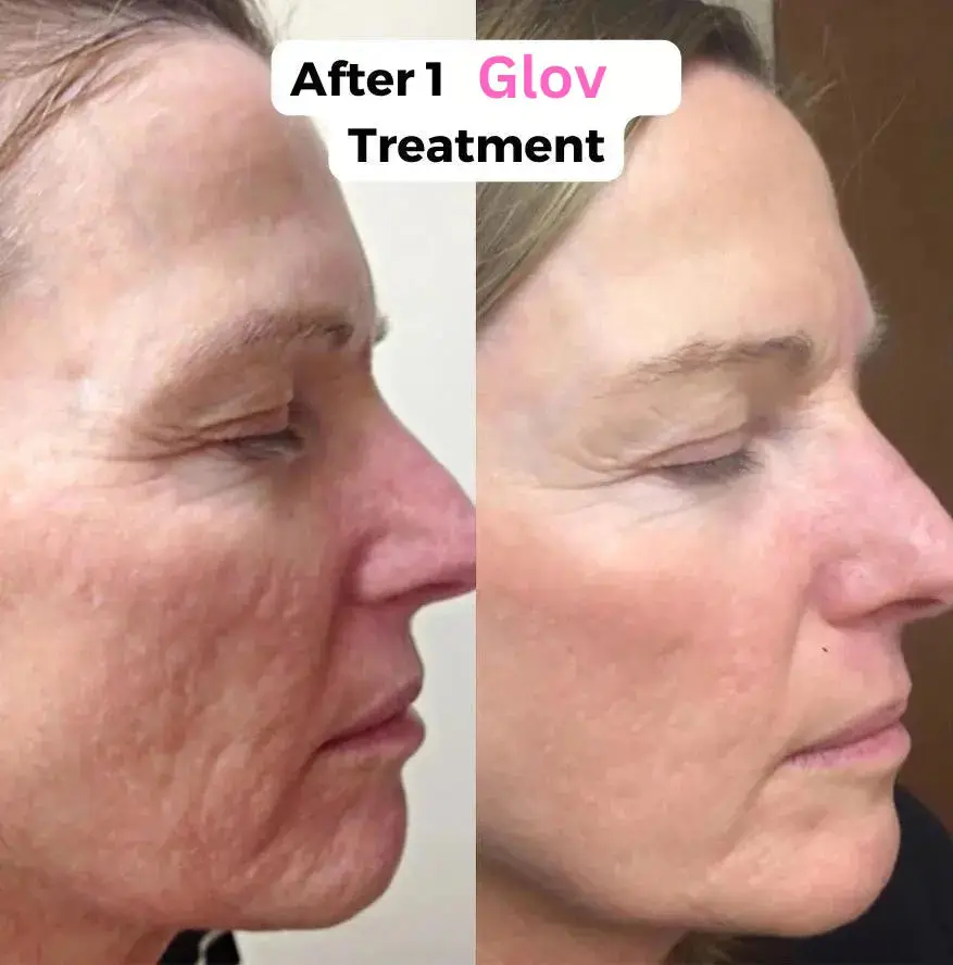 Glov Micro Infusion System Bundle - Image 5
