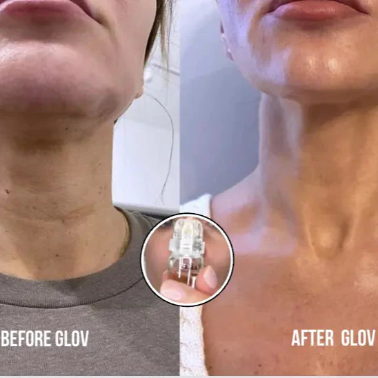 Glov Micro Infusion System - Image 6